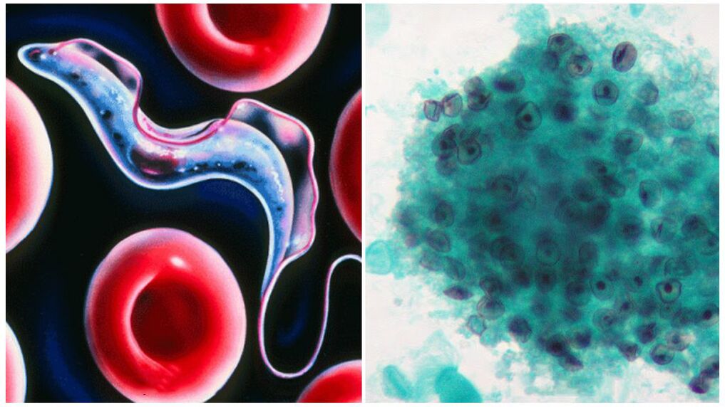 Pneumocystes dans le corps